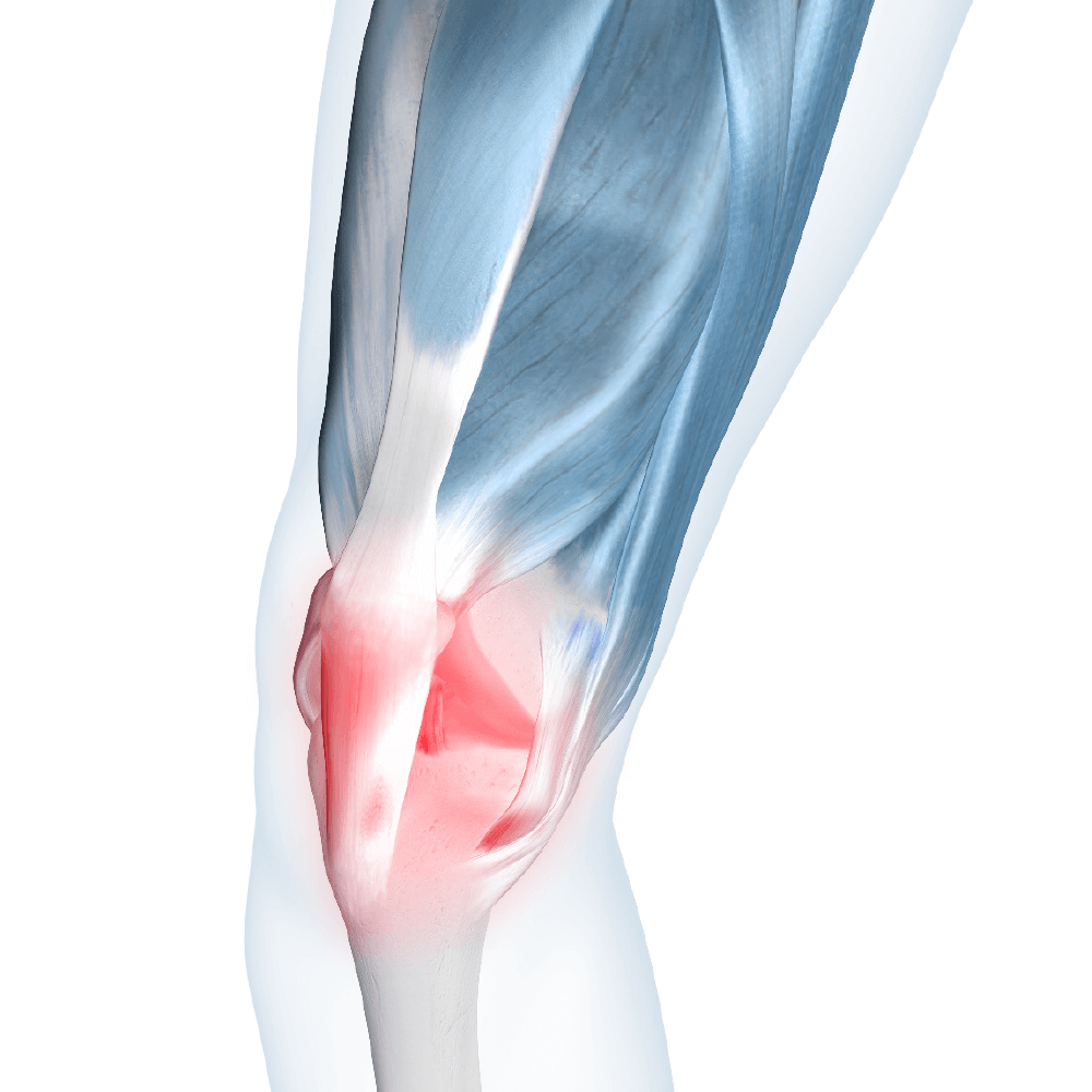 Illustration of knee joint highlighting the area affected by patellar tendonitis.