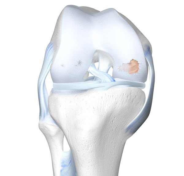 Illustration of a human knee joint showing cartilage damage.