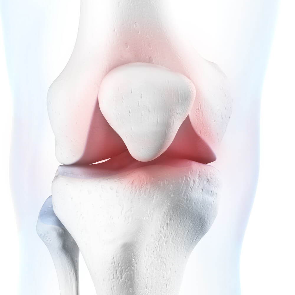 Close-up illustration of a knee joint with pain and inflammation.