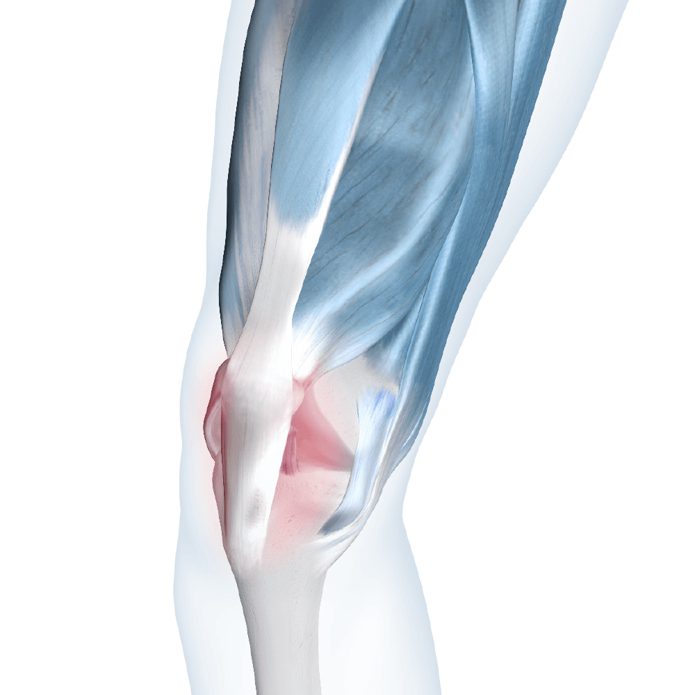 Illustration of knee joint highlighting the area affected by runner's knee.