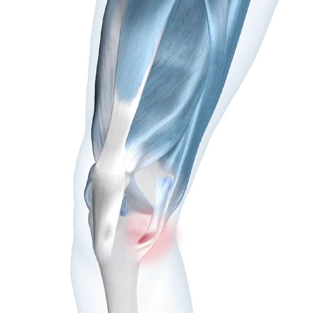 Illustration of knee joint highlighting the area affected by pes anserine bursitis.